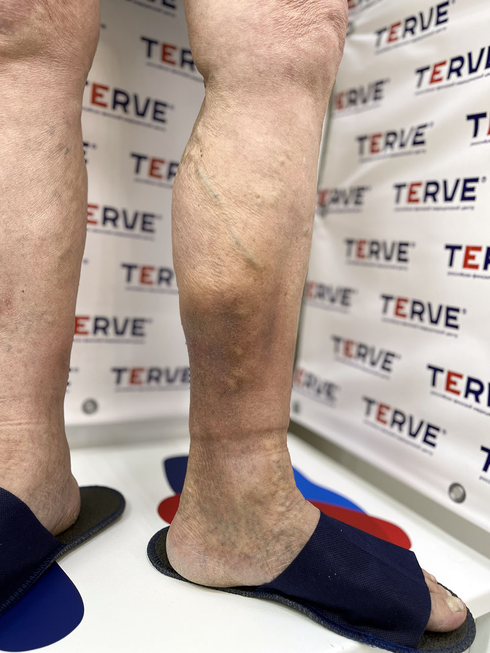 Флебология - Услуги - Сеть медицинских центров TERVE